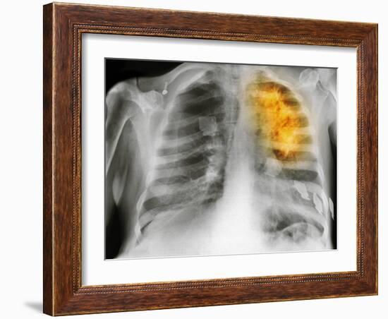 Lung Cancer, X-ray-Science Photo Library-Framed Photographic Print