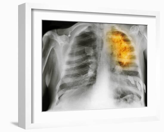 Lung Cancer, X-ray-Science Photo Library-Framed Photographic Print