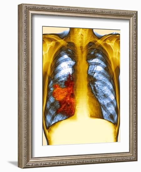 Lung Cancer, X-ray-Du Cane Medical-Framed Photographic Print