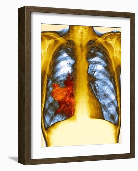 Lung Cancer, X-ray-Du Cane Medical-Framed Photographic Print