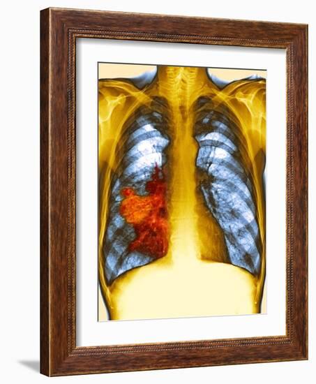 Lung Cancer, X-ray-Du Cane Medical-Framed Photographic Print