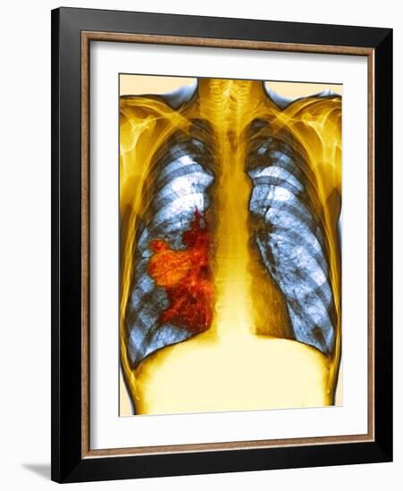 Lung Cancer, X-ray-Du Cane Medical-Framed Photographic Print