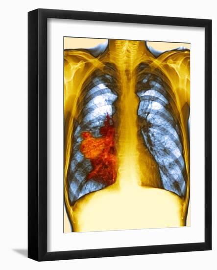 Lung Cancer, X-ray-Du Cane Medical-Framed Photographic Print