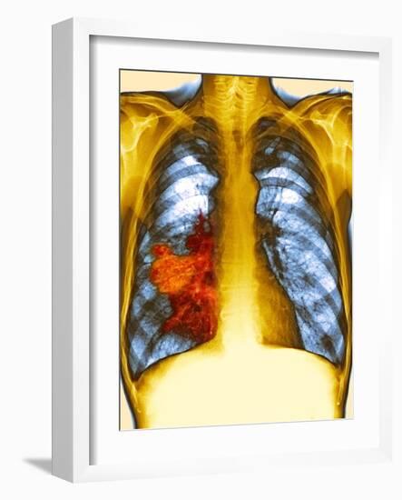 Lung Cancer, X-ray-Du Cane Medical-Framed Photographic Print