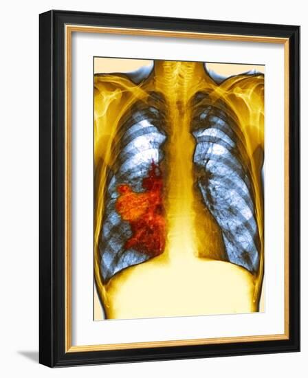 Lung Cancer, X-ray-Du Cane Medical-Framed Photographic Print