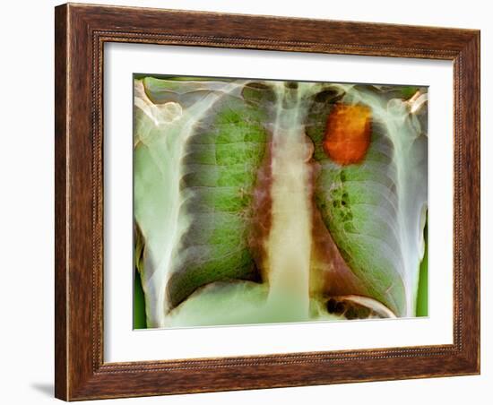 Lung Cancer, X-ray-Du Cane Medical-Framed Photographic Print