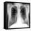 Lung Cancer, X-ray-Du Cane Medical-Framed Premier Image Canvas