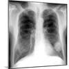 Lung Cancer, X-ray-Du Cane Medical-Mounted Photographic Print