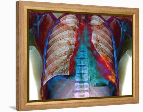 Lung Infection-Du Cane Medical-Framed Premier Image Canvas