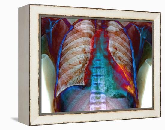 Lung Infection-Du Cane Medical-Framed Premier Image Canvas