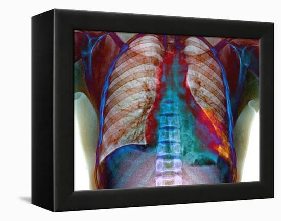 Lung Infection-Du Cane Medical-Framed Premier Image Canvas