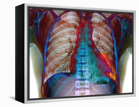 Lung Infection-Du Cane Medical-Framed Premier Image Canvas