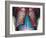 Lung Infection-Du Cane Medical-Framed Photographic Print