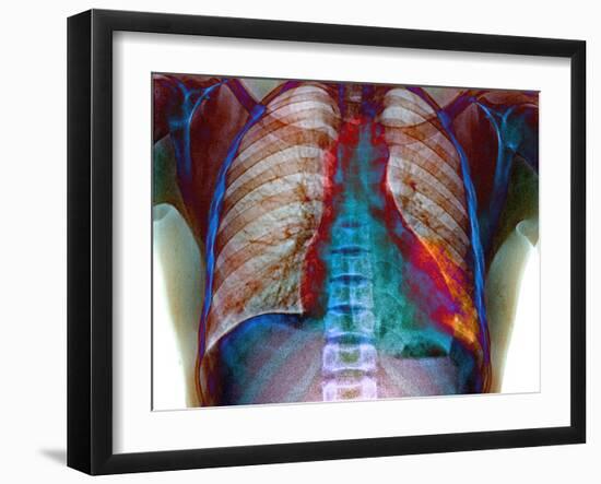 Lung Infection-Du Cane Medical-Framed Photographic Print