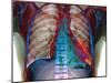 Lung Infection-Du Cane Medical-Mounted Photographic Print