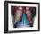 Lung Infection-Du Cane Medical-Framed Photographic Print