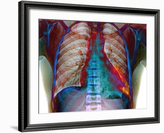 Lung Infection-Du Cane Medical-Framed Photographic Print