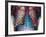 Lung Infection-Du Cane Medical-Framed Photographic Print