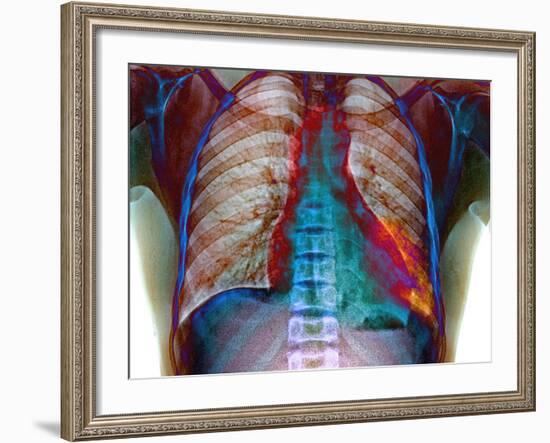 Lung Infection-Du Cane Medical-Framed Photographic Print