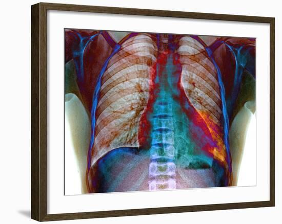 Lung Infection-Du Cane Medical-Framed Photographic Print