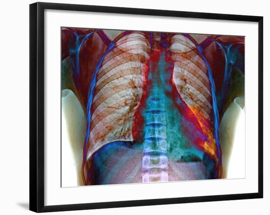 Lung Infection-Du Cane Medical-Framed Photographic Print