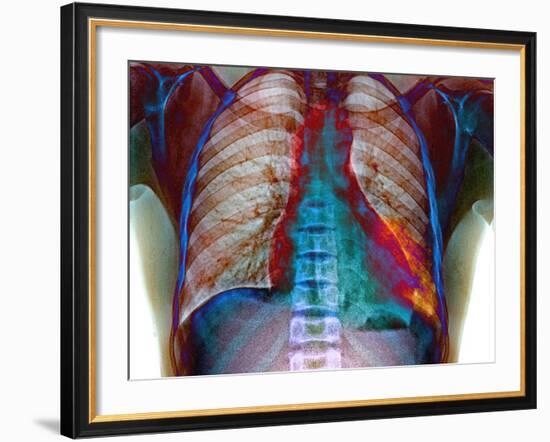 Lung Infection-Du Cane Medical-Framed Photographic Print