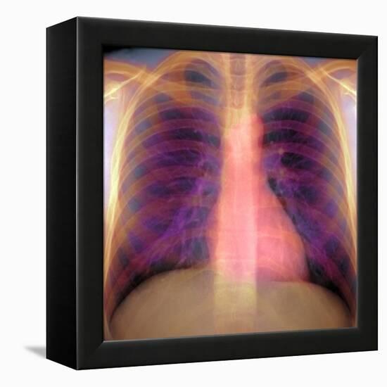 Lungs And Heart, X-ray-Du Cane Medical-Framed Premier Image Canvas