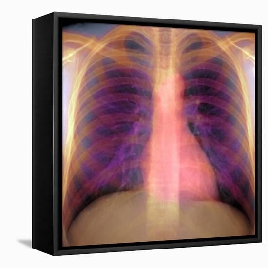 Lungs And Heart, X-ray-Du Cane Medical-Framed Premier Image Canvas