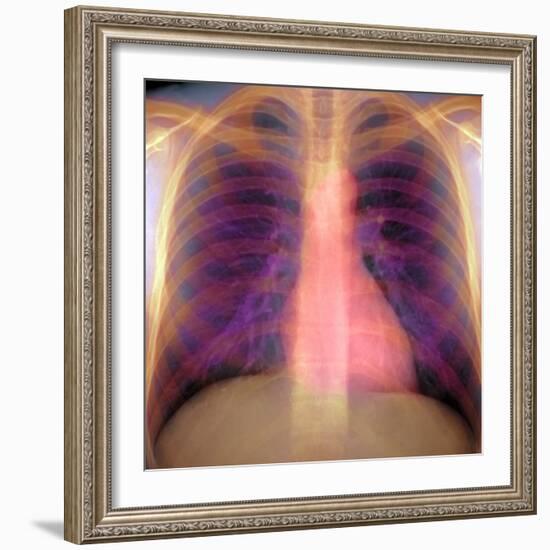 Lungs And Heart, X-ray-Du Cane Medical-Framed Premium Photographic Print