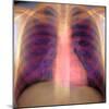 Lungs And Heart, X-ray-Du Cane Medical-Mounted Premium Photographic Print