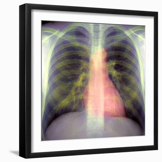 Lungs And Heart, X-ray-Du Cane Medical-Framed Premium Photographic Print