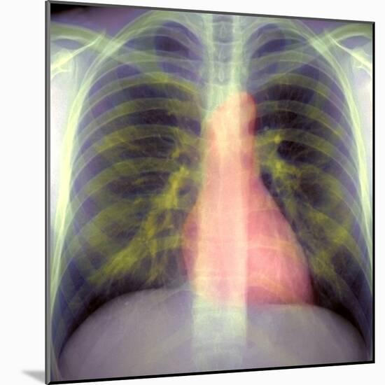 Lungs And Heart, X-ray-Du Cane Medical-Mounted Premium Photographic Print