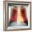 Lungs And Heart, X-ray-Du Cane Medical-Framed Premium Photographic Print