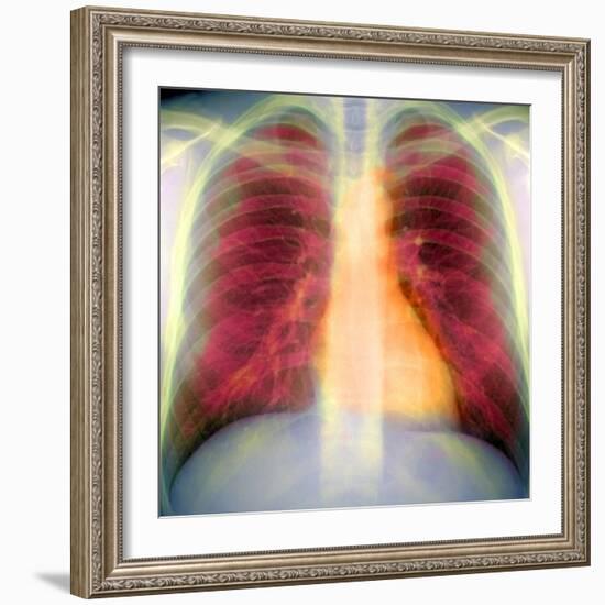 Lungs And Heart, X-ray-Du Cane Medical-Framed Premium Photographic Print