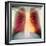 Lungs And Heart, X-ray-Du Cane Medical-Framed Premium Photographic Print