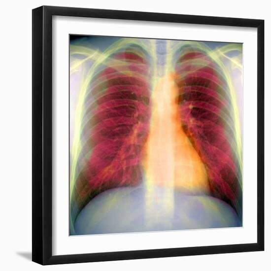 Lungs And Heart, X-ray-Du Cane Medical-Framed Premium Photographic Print