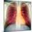 Lungs And Heart, X-ray-Du Cane Medical-Mounted Premium Photographic Print