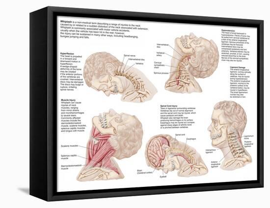 Medical Chart Showing the Range of Injuries to the Human Neck Caused by Whiplash-null-Framed Stretched Canvas