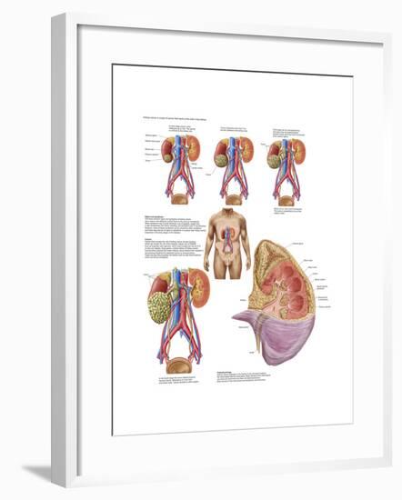 Medical Chart Showing the Signs and Symptoms of Kidney Cancer-null-Framed Art Print