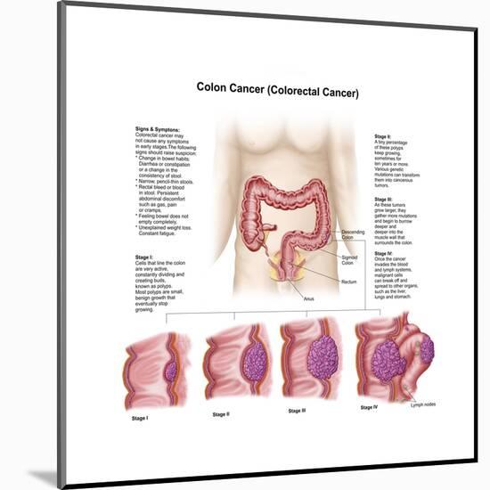 Medical Illustration Depicting the Different Stages of Colon Cancer-null-Mounted Art Print