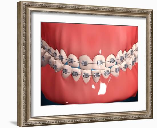 Medical Illustration of Human Mouth Showing Teeth, Gums and Metal Braces-null-Framed Art Print