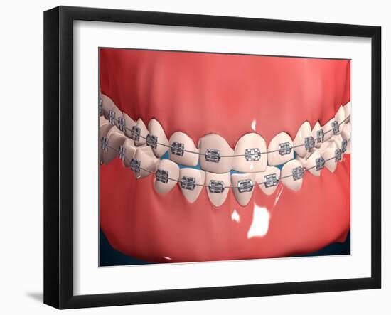 Medical Illustration of Human Mouth Showing Teeth, Gums and Metal Braces-null-Framed Art Print