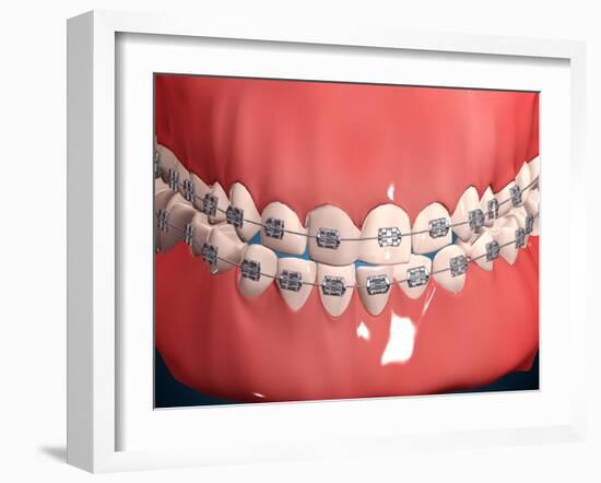 Medical Illustration of Human Mouth Showing Teeth, Gums and Metal Braces-null-Framed Art Print