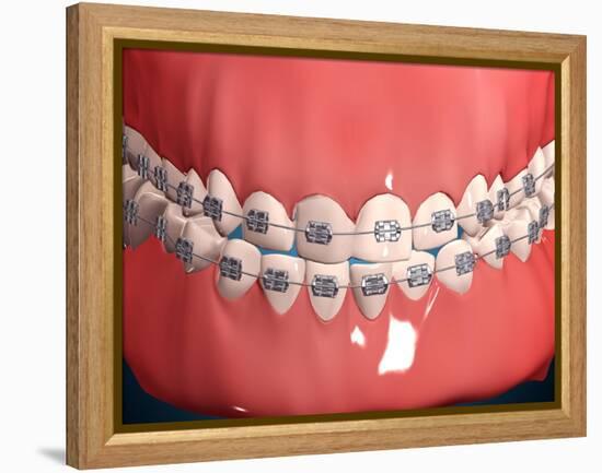 Medical Illustration of Human Mouth Showing Teeth, Gums and Metal Braces-null-Framed Stretched Canvas