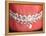 Medical Illustration of Human Mouth Showing Teeth, Gums and Metal Braces-null-Framed Stretched Canvas