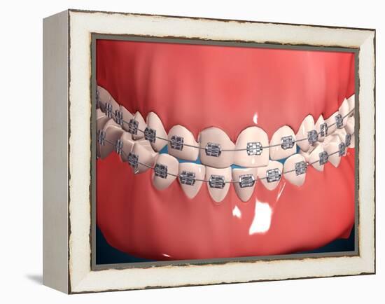 Medical Illustration of Human Mouth Showing Teeth, Gums and Metal Braces-null-Framed Stretched Canvas