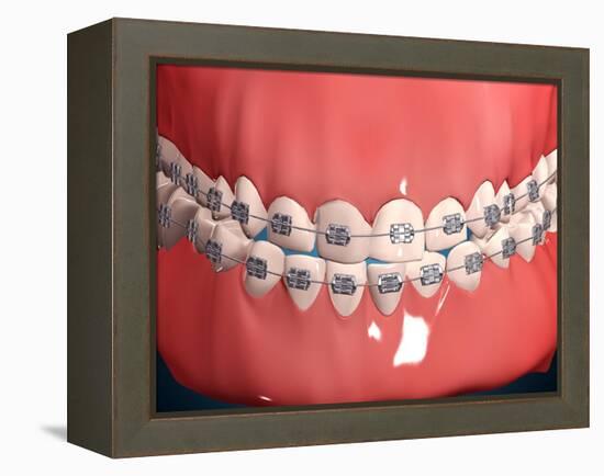 Medical Illustration of Human Mouth Showing Teeth, Gums and Metal Braces-null-Framed Stretched Canvas