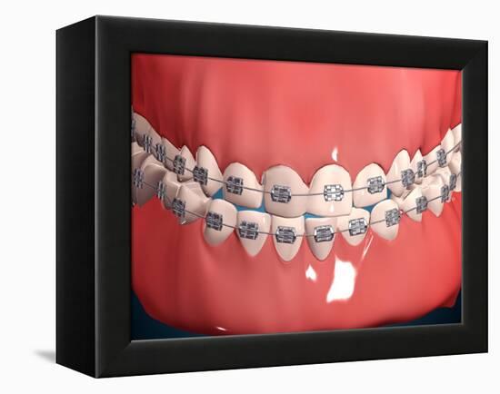 Medical Illustration of Human Mouth Showing Teeth, Gums and Metal Braces-null-Framed Stretched Canvas