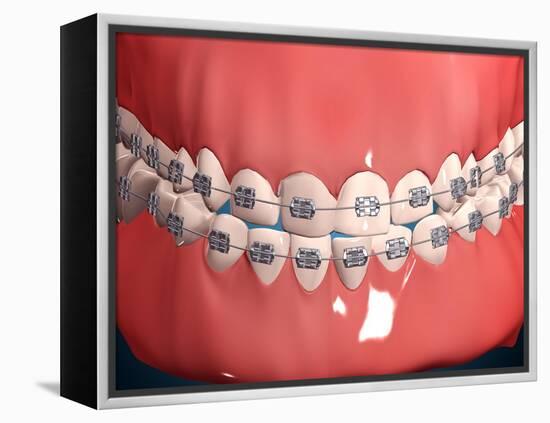 Medical Illustration of Human Mouth Showing Teeth, Gums and Metal Braces-null-Framed Stretched Canvas