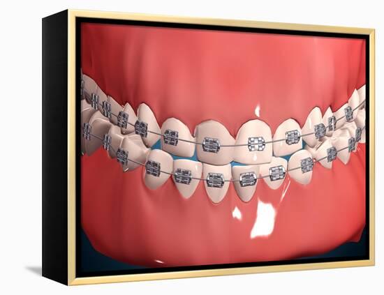 Medical Illustration of Human Mouth Showing Teeth, Gums and Metal Braces-null-Framed Stretched Canvas